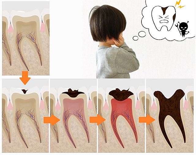 むし歯