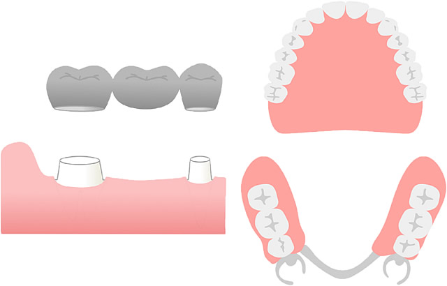 入れ歯・ブリッジ